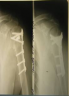 Новый подход к лечению больных с переломами проксимального отдела плечевой кости 14. 01. 15 Травматология и ортопедия preview 2