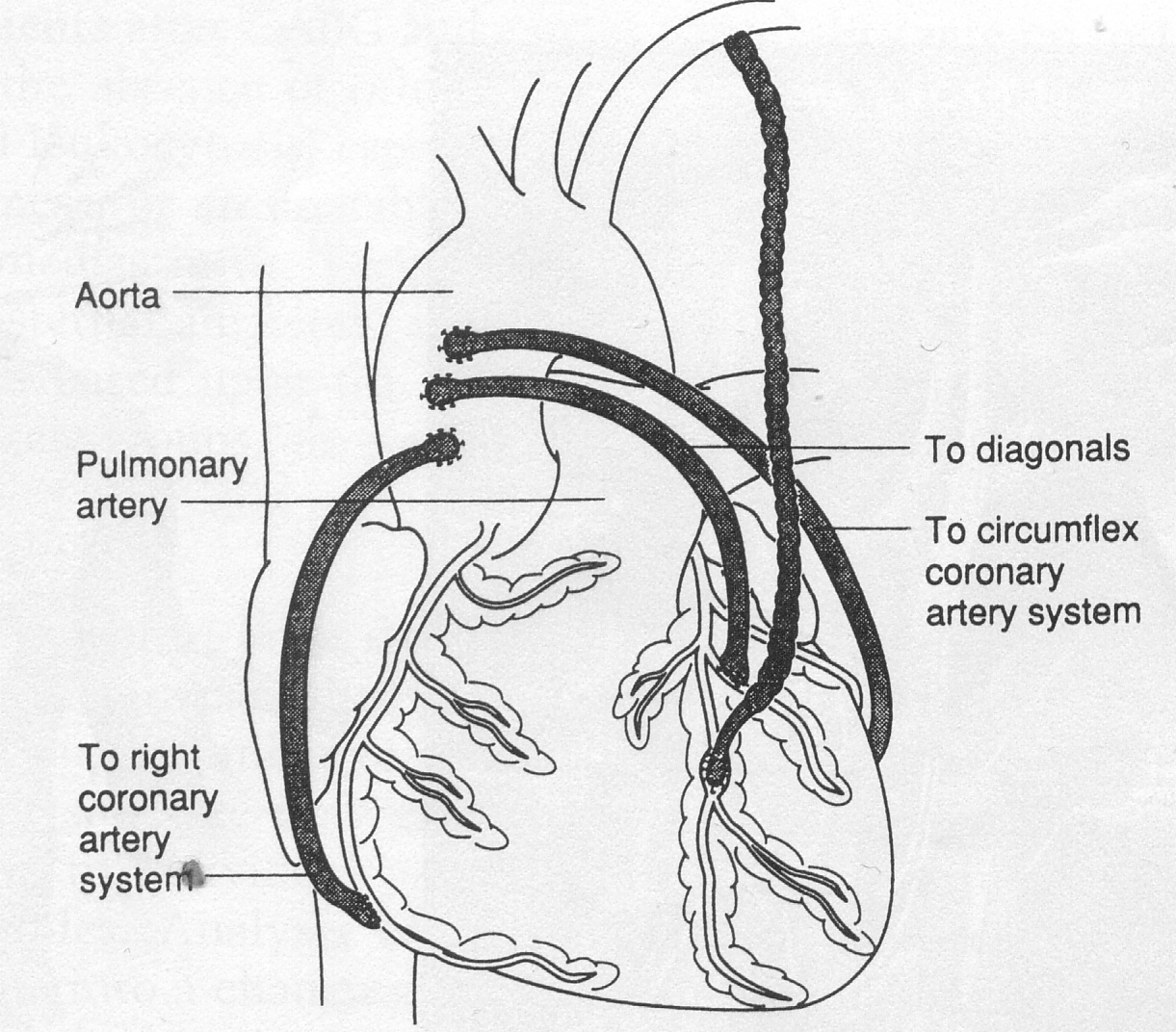 Что такое шунтирование сердца и сосудов. Шунтирование коронарных артерий схема. Схема операции аортокоронарного шунтирования. Маммарокоронарное шунтирование ПМЖВ что это такое. Маммарокоронарное шунтирование схема.